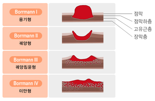 진행위암의 보우만(Borrmann)분류 - Borrmann I 융기형, Borrmann II 궤양형, Borrmann III 궤양침윤형, Borrmann IV 미만형,  점막, 점막하층, 고유근층, 장막층

1111111111